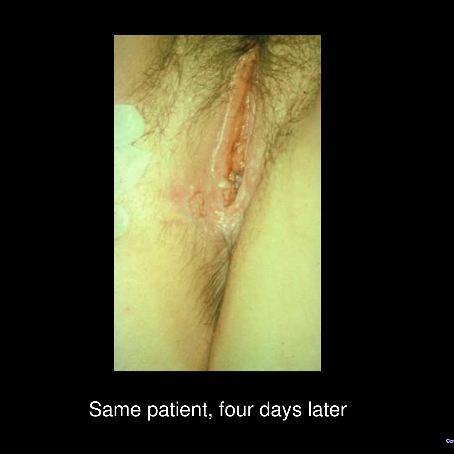 Perianal herpes simplex infection with vesicular lesions and erosions around anal orifice common in men who have sex with men
